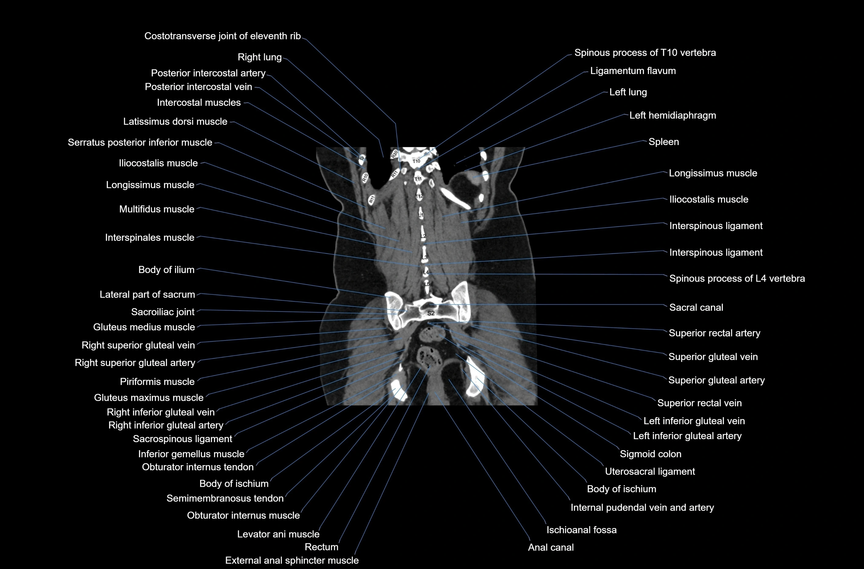 CT abdomen coronal cross sectional anatomy labelled radiology image-00070.webp
